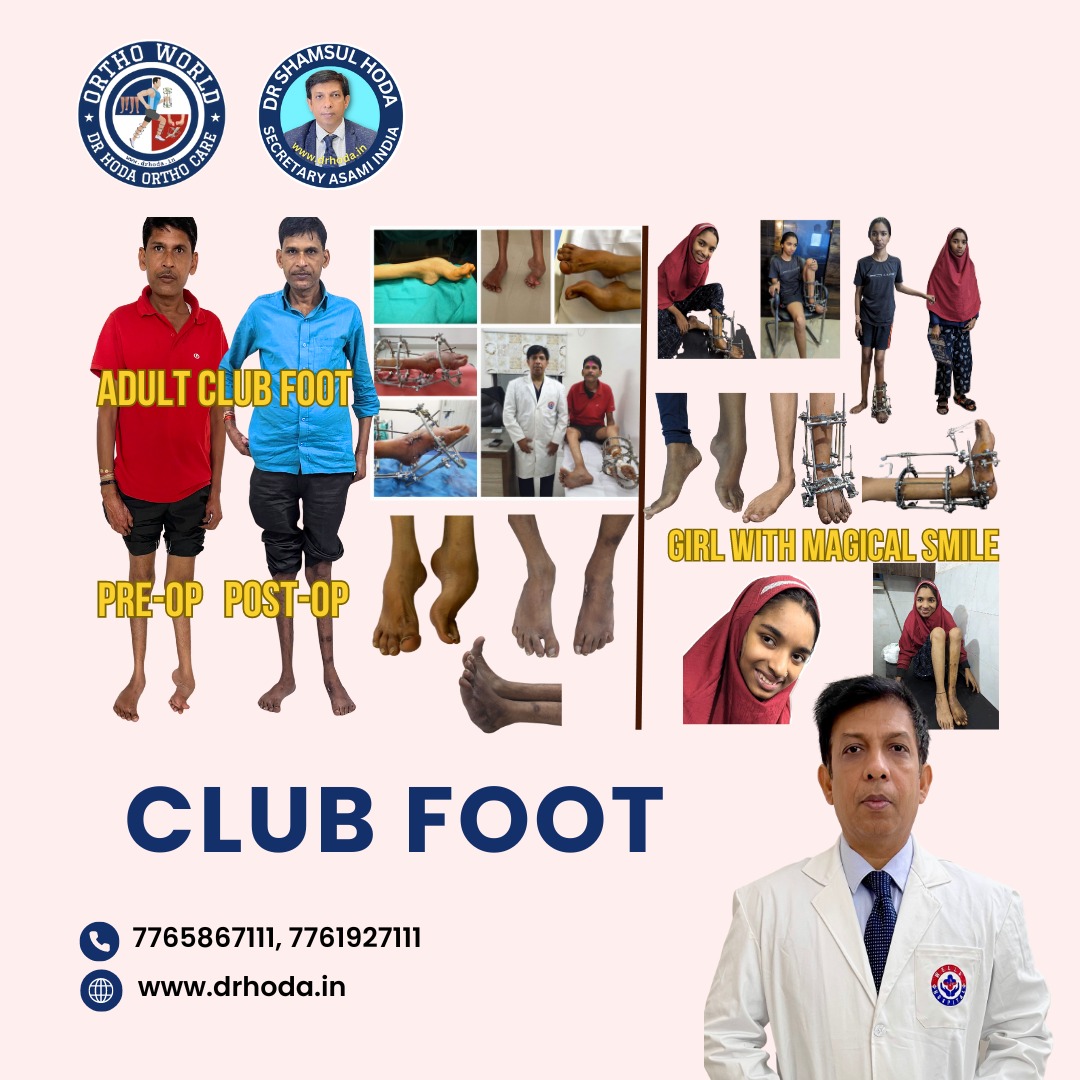 Club Foot