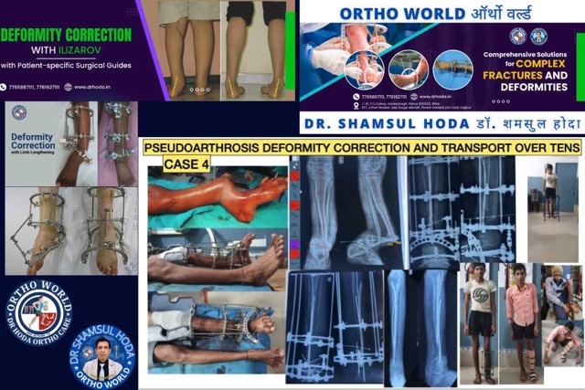 Pseudoarthrosis Limb Deformity Correction & Lengthening With Ilizarov