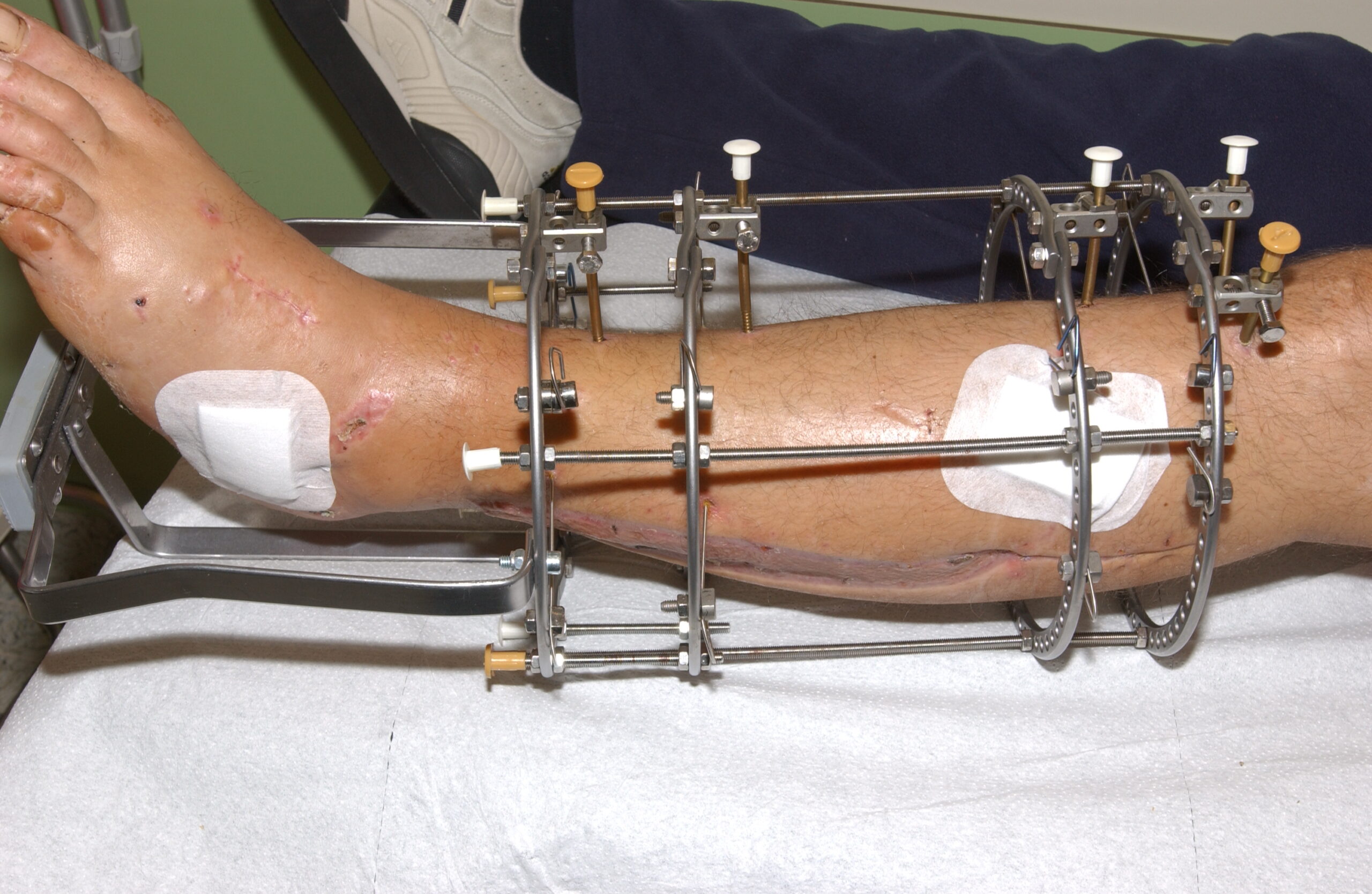 Ilizarov & Complex Trauma