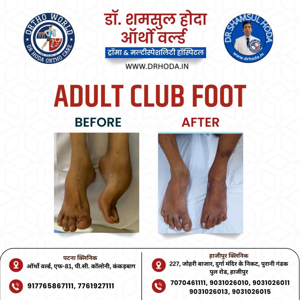 Club Foot (CTEV) Treatment by Ilizarov