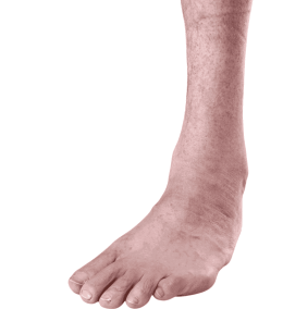 clubfoot clubfoot